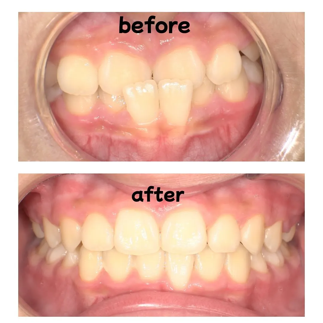 プレオルソの症例について🫧