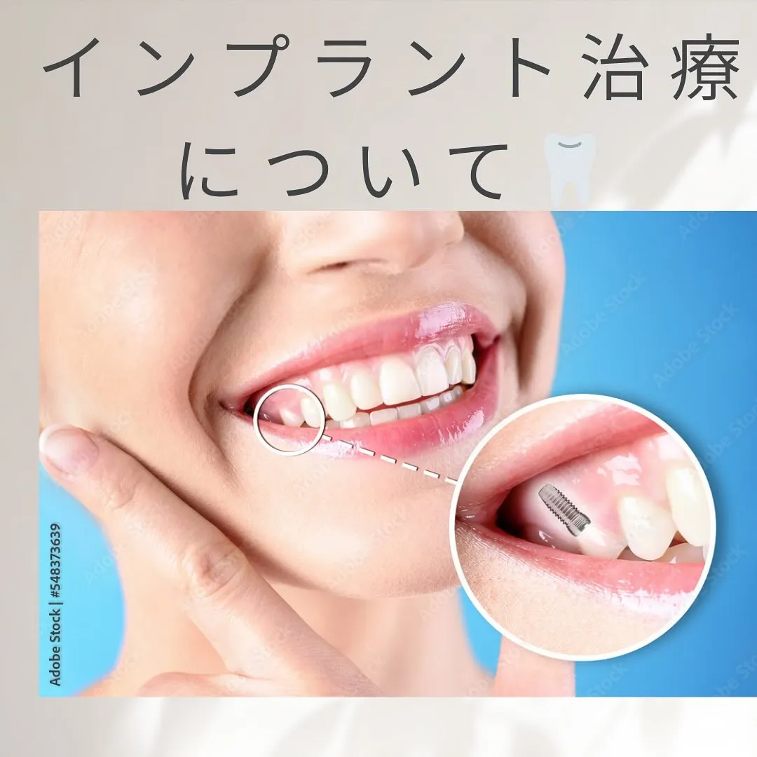 インプラント治療について