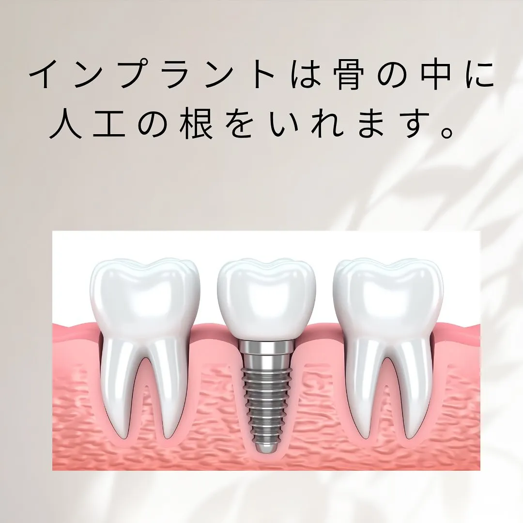 インプラント治療について