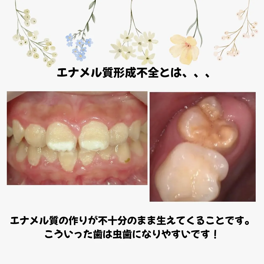 エナメル質形成不全について