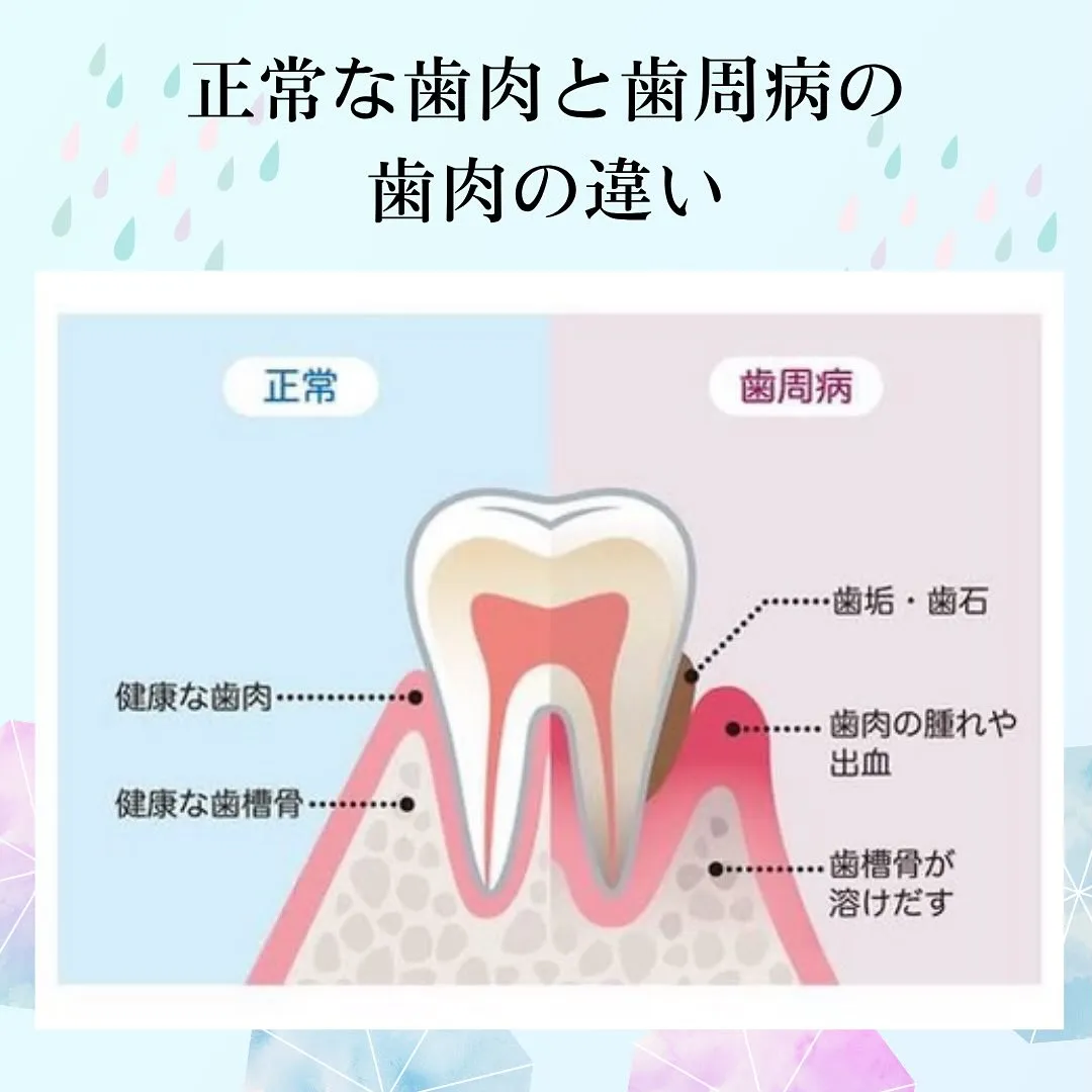 歯周病について