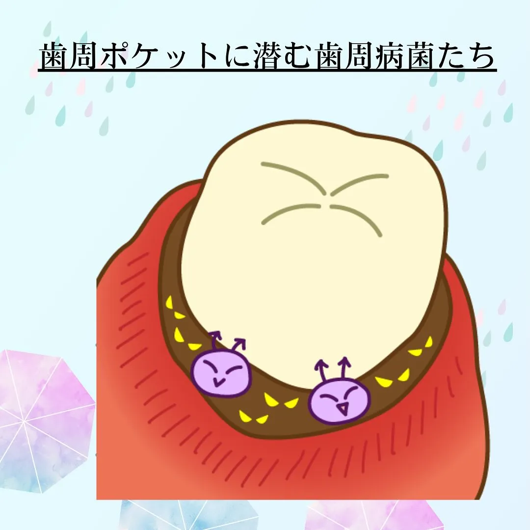 歯周病について