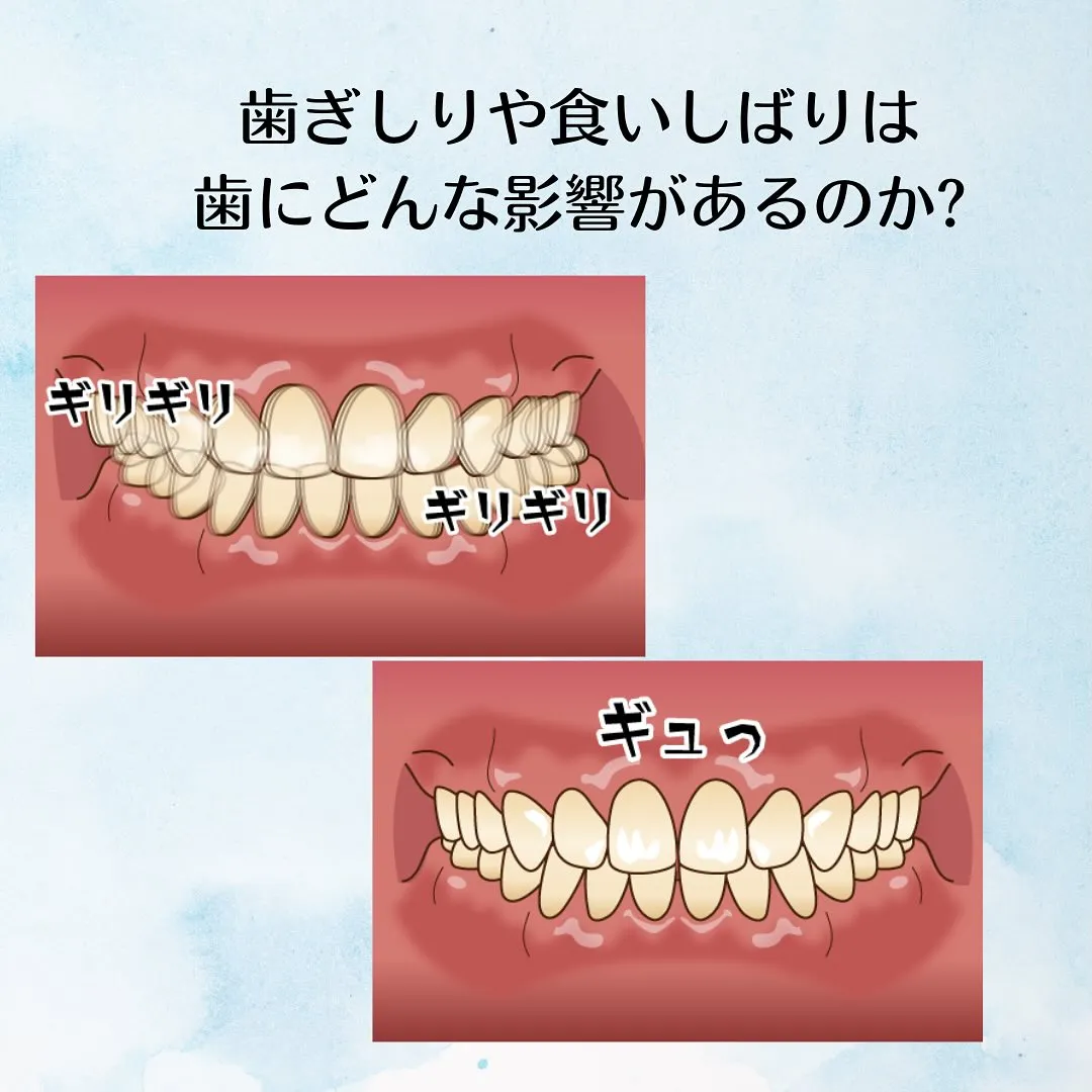 歯ぎしり、食いしばりについて