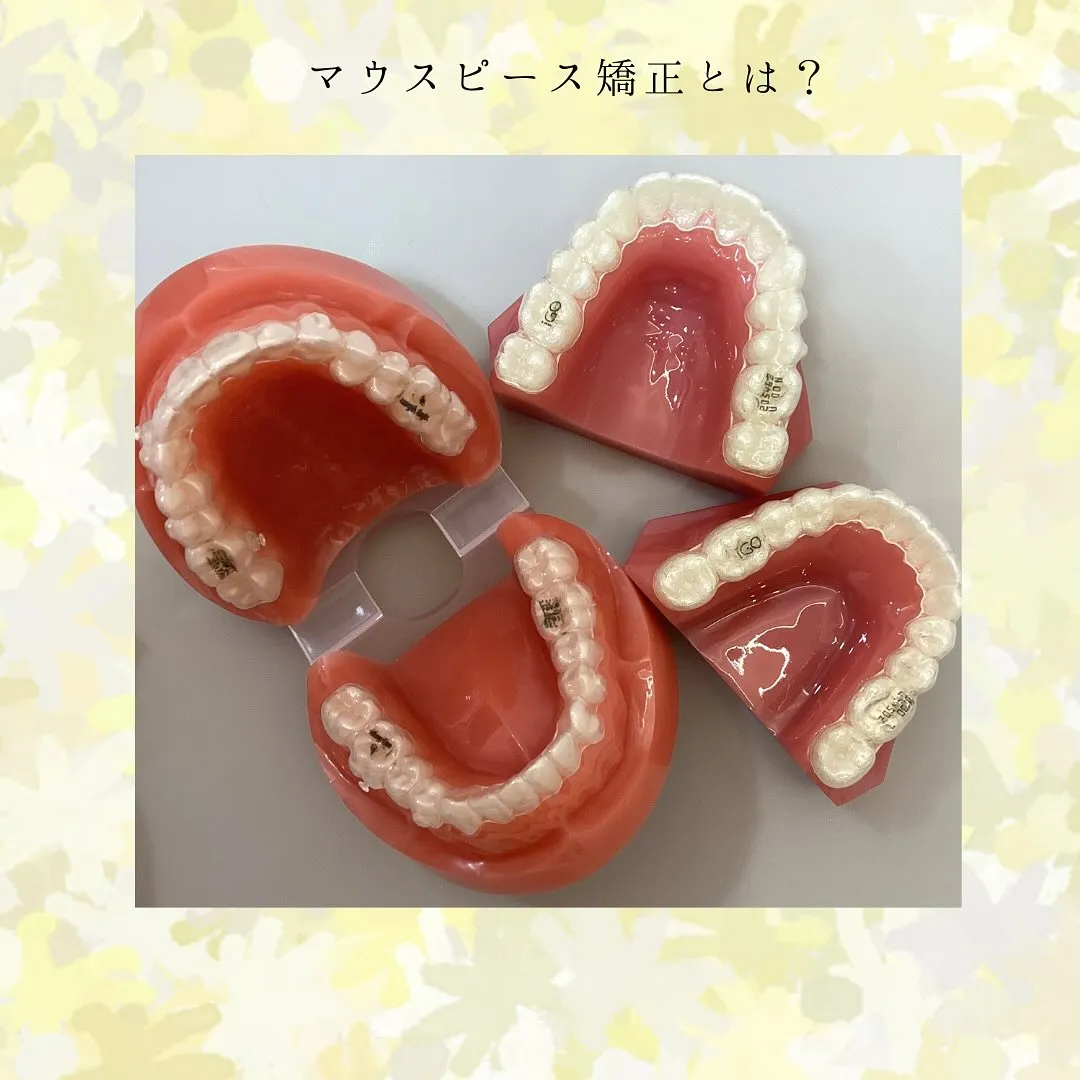 マウスピース矯正とは?