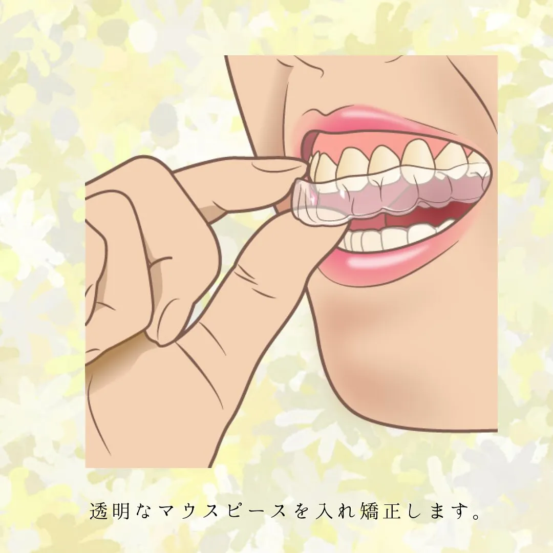 マウスピース矯正とは?