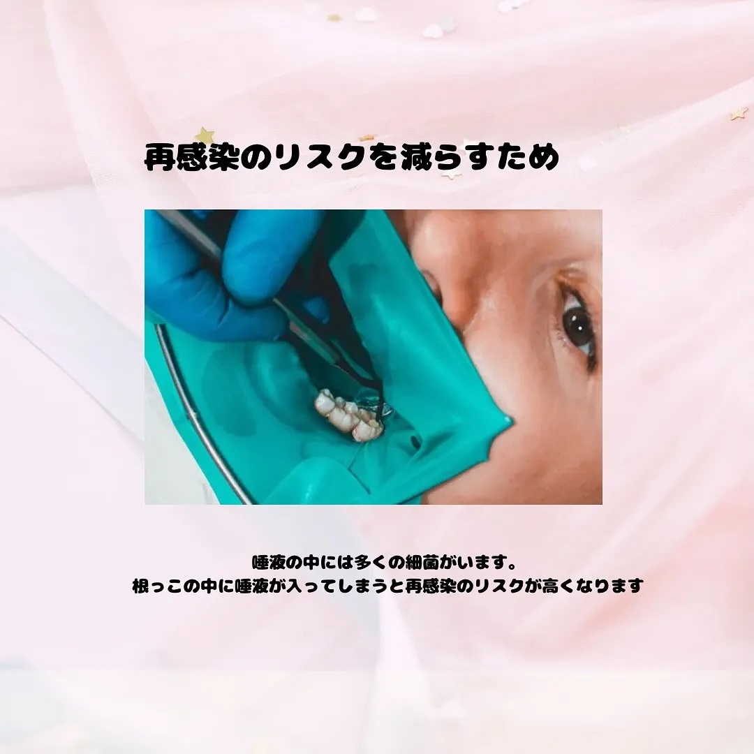 ラバーダム防湿って??